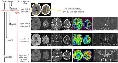 Case report: Three characteristics of tyrosine kinase inhibitor-associated cerebrovascular stenosis. High threshold for infarction, atypical infarct area, and vascular recoverability under the use of ponatinib
